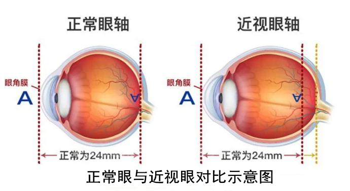 女子近视3000度被迫摘除眼球，高度近视的你要当心视网膜脱落！